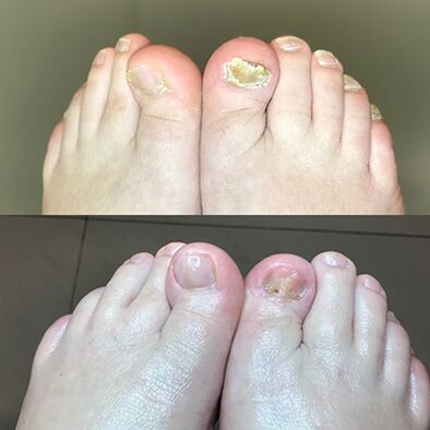 Εμπειρία στη χρήση της Promic Cream Barnabas από το Ισραήλ, φωτογραφία πριν και μετά