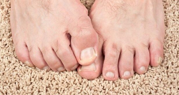 Συμπτώματα μύκητα νυχιών