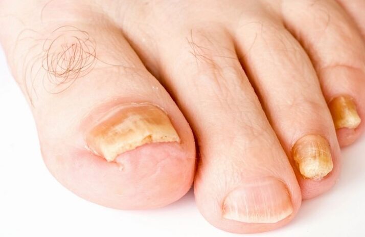 Το μανιτάρι στον αντίχειρα του ποδιού