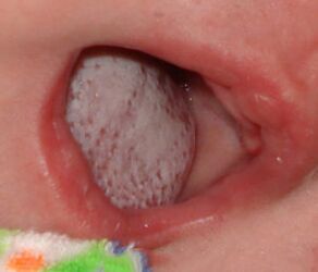 Εντοπισμός της νόσου με μανιτάρι