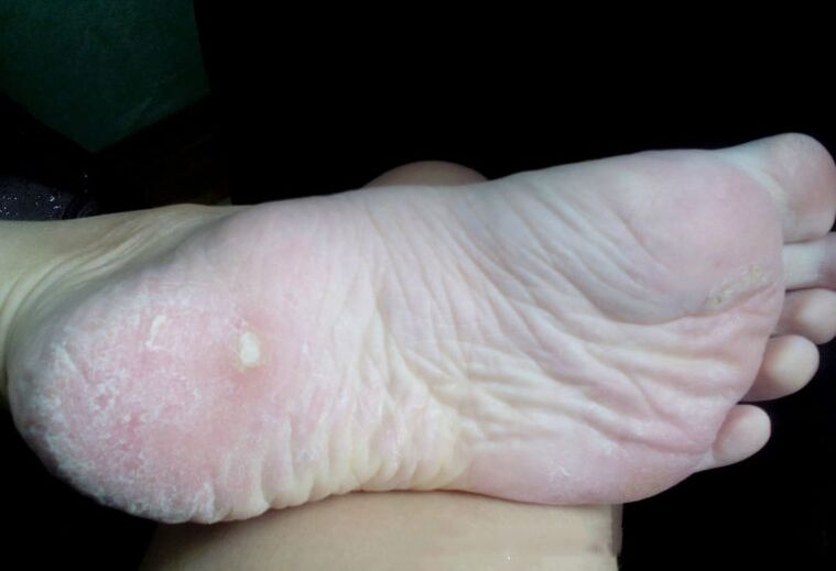 Θεραπεία του μανιταριού με λέιζερ