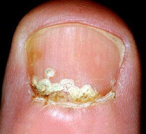 Συμπτώματα και σημεία της νόσου