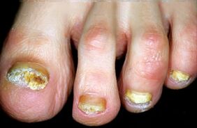 Χαρακτηρισμός της νόσου