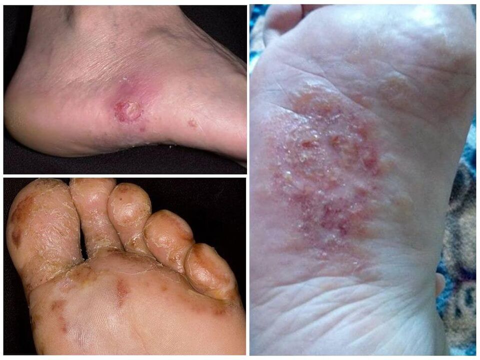 Dyshidrotic mycosis