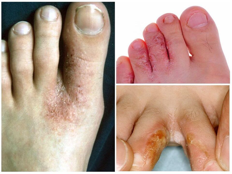 Μεσοδακτυλική μυκητίαση