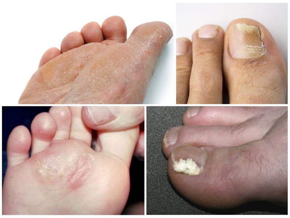 Το αρχικό στάδιο του ποδιού του αθλητή