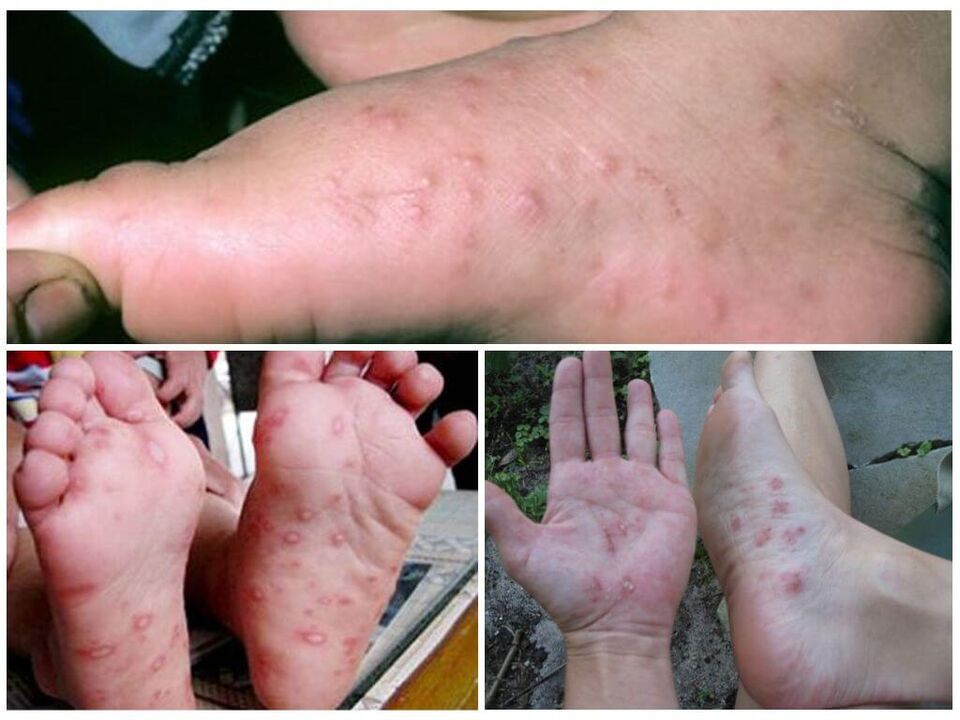 Υπερκερατωτικές βλάβες των ποδιών