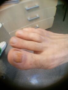 Αρχικό στάδιο του μύκητα των νυχιών στο μεγάλο δάχτυλο του ποδιού