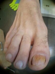 Μύκητας νυχιών στο μεγάλο δάχτυλο του ποδιού