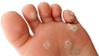 δεύτερο στάδιο μιας μυκητιασικής λοίμωξης