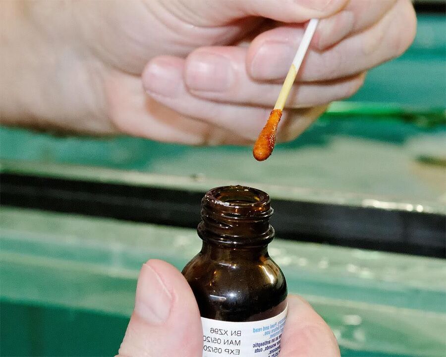 Η εφαρμογή ενός μείγματος ιωδίου και χυμού φελαντίνης στα νύχια των ποδιών εξαλείφει τους μύκητες